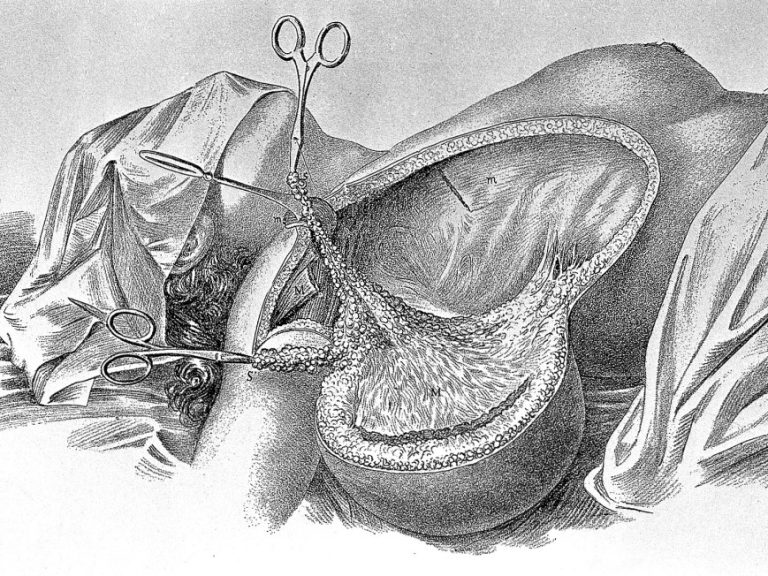 William Halsted performed the first radical mastectomy