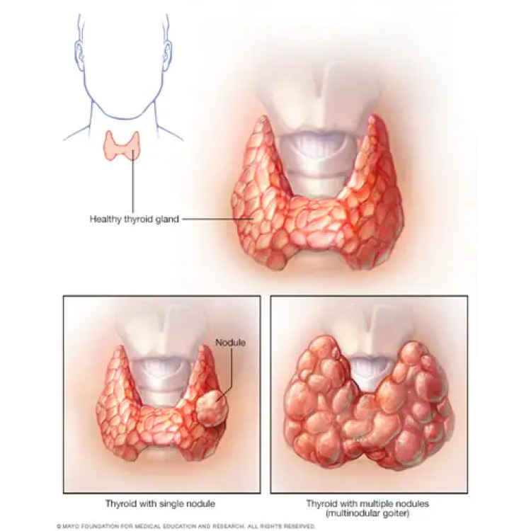 David Marine and colleagues initiated an iodine prophylaxis program in over 2100 schoolgirls