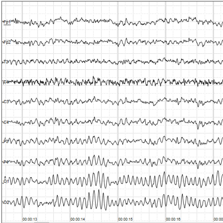 A University of Iowa laboratory was the first to record human electroencephalograph (EEG) activity