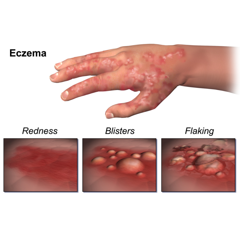 Louis Schwartz and H. R. Foerster described industrial dermatitis and melanosis due to photosensitization