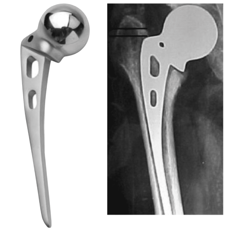 The first metallic hip replacement surgery was performed