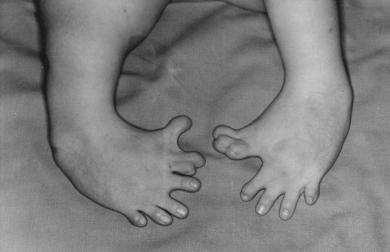 The first Thalidomide birth occurred in Germany