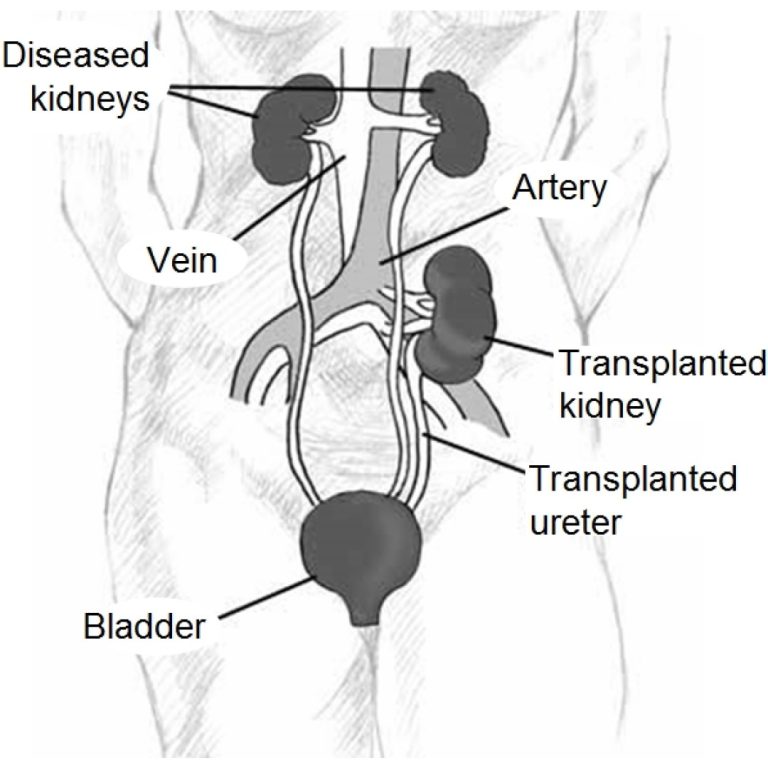 OHSU transplanted its first organ, just the 18th successful kidney transplant in the world