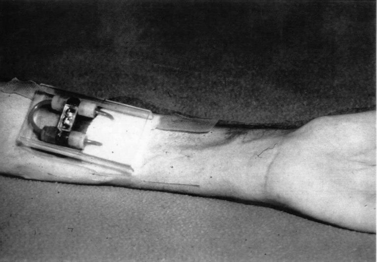 The first ‘Scribner shunt’ was implanted in the arm of a Boeing machinist