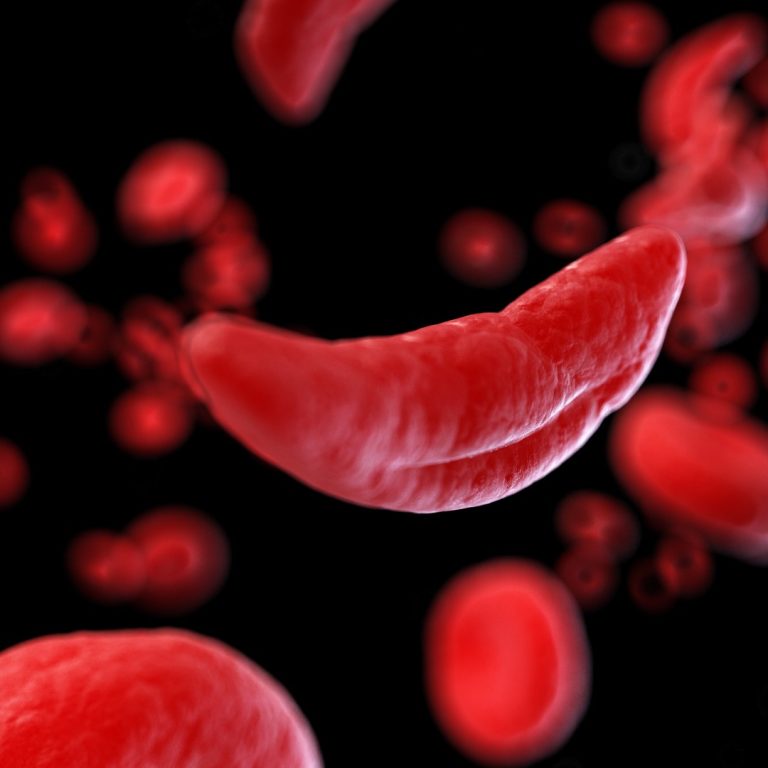 The first documented case of sickle cell disease, with full autopsy findings, was published at Medical College of Georgia