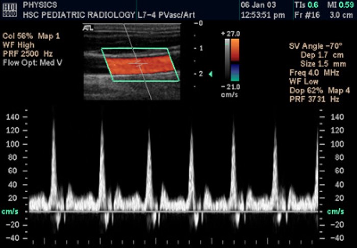 University of Washington researchers published first reports of ultrasonic duplex scanning for arterial and venous disorders