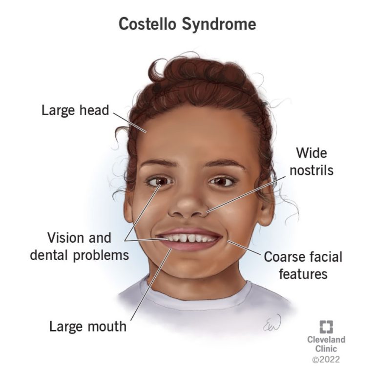 Dr. Jack Costello first identified a genetic disorder, now known as Costello syndrome