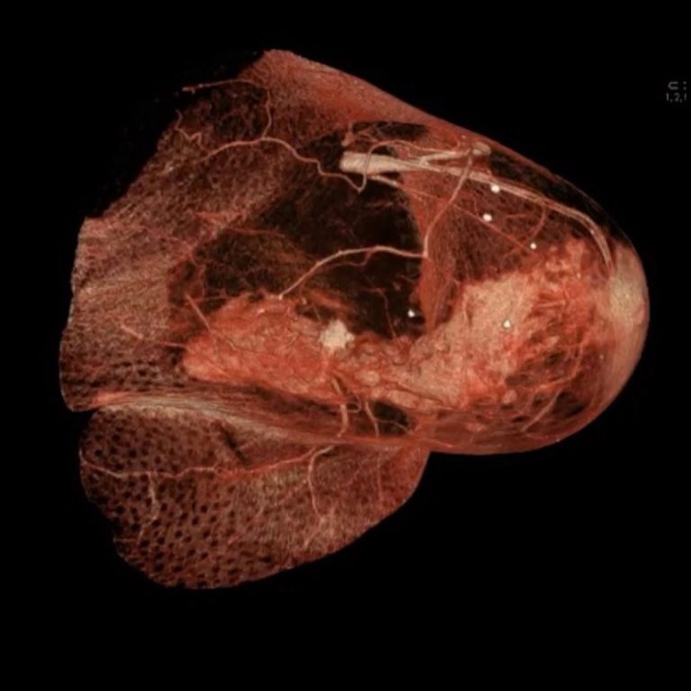 Metastatic cells were shown to arise from pre-existing subpopulations of cells in primary tumors