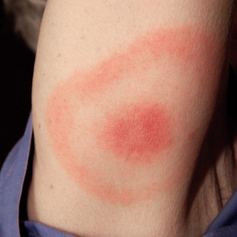 CDC Launched National surveillance for Lyme disease