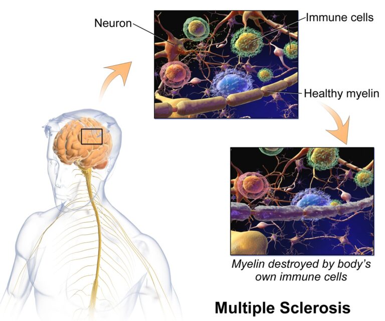 FDA approved Betaseron, the first of several biotech products that have had a major impact on multiple sclerosis treatment