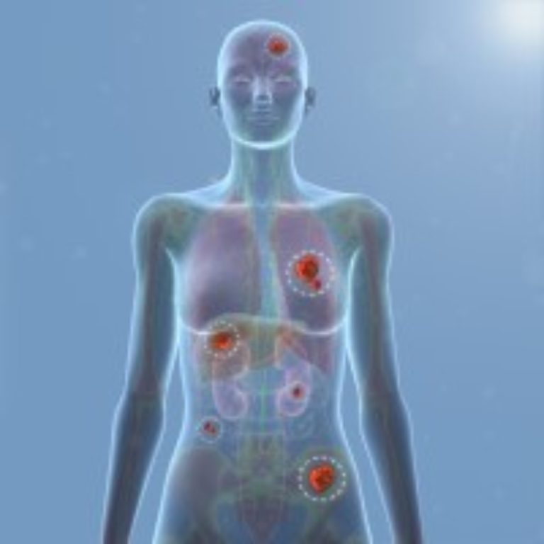 Breast and ovarian cancer linked to thousands of gene variants