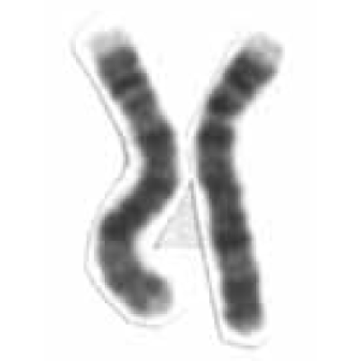 A gene associated with Parkinson’s disease was discovered