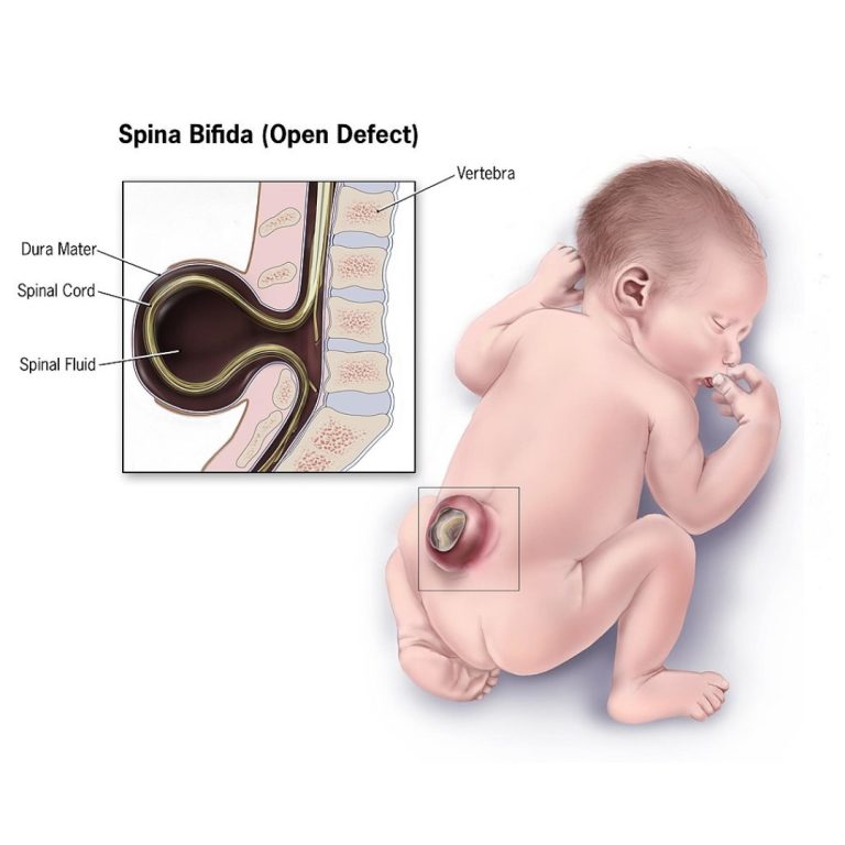 Dr. Philippe Gros and his team of McGill University researchers identified a gene that causes spina bifida