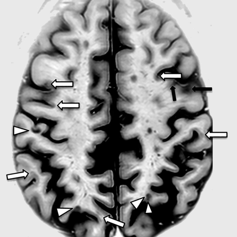 University of British Columbia researchers discovered a genetic link to multiple sclerosis