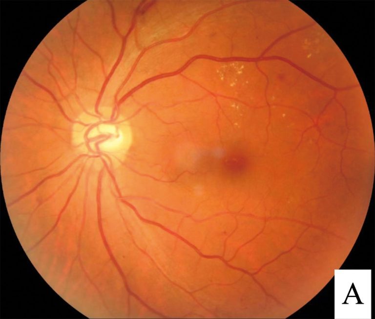 Lucentis approved for treatment of diabetic macular edema