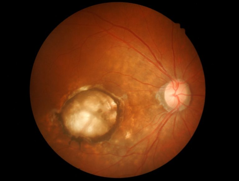 UNMC macular degeneration, regenerative medicine research bolstered by $1.3 million gift