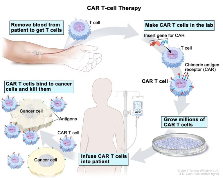 Siteman Cancer Center became one of the first cancer centers nationwide to offer newly approved CAR-T cell therapy called Yescarta