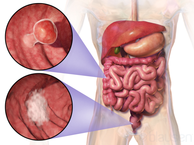 National Cancer Institute scientists reported low-dose drug combination cuts risk of colon polyp recurrence