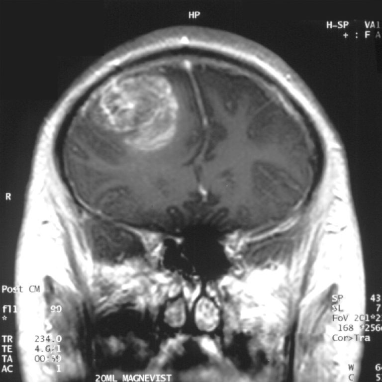 Pascal Biosciences announced optimization of cannabinoid-derived drug candidates to kill glioblastoma cells