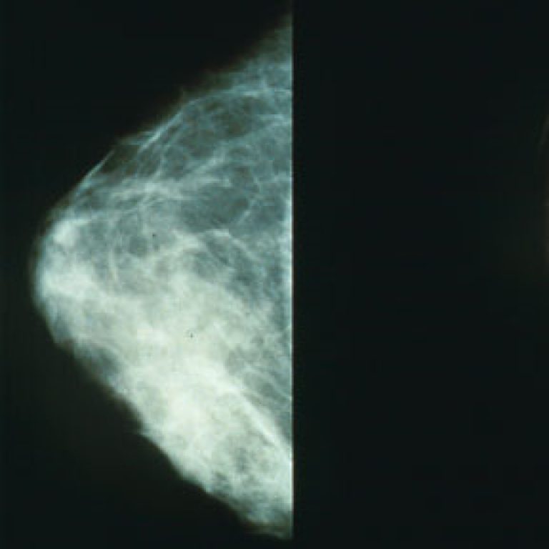 The FDA approved new treatment option for patients with HER2-positive breast cancer