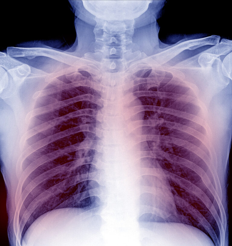 MediciNova announced plans to develop MN-166 (ibudilast) for severe pneumonia and ARDS