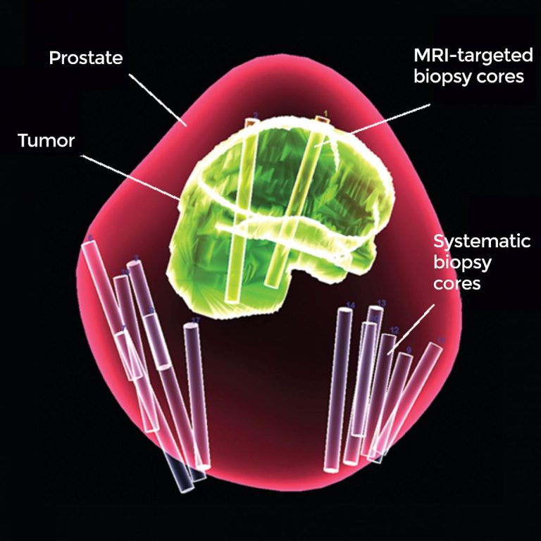 National Cancer Institute researchers discovered common variations in gene segments that increase risk for prostate cancer