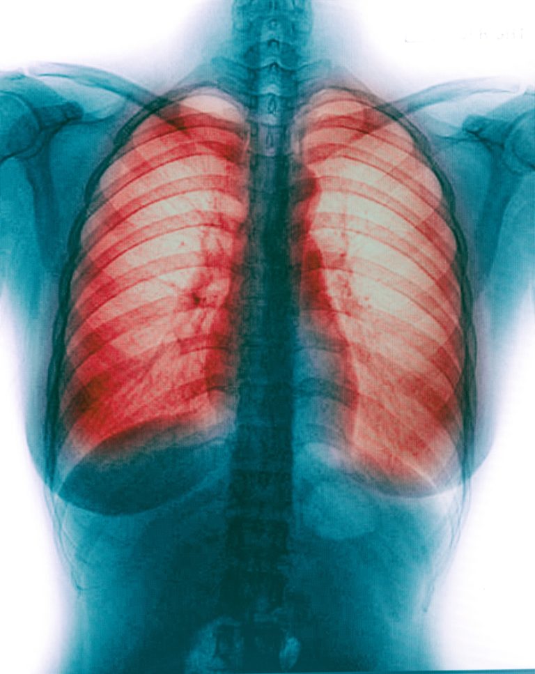 FDA approved Trelegy Ellipta as first once-daily single inhaler triple therapy for treatment of both asthma and COPD in the U.S.