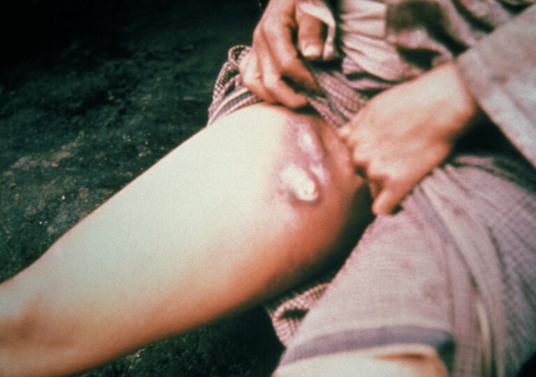 Dynavax and U.S. Department of Defense announce collaboration to develop adjuvanted plague vaccine