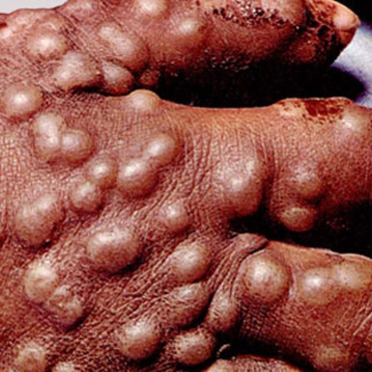 The New York City General Assembly prohibited people from smallpox infected areas from entering the city