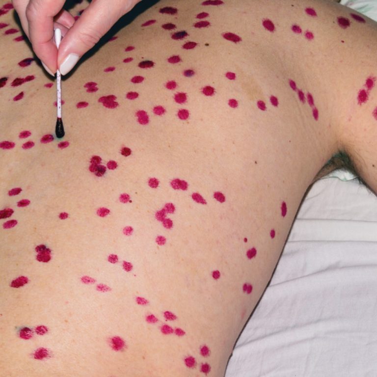 CDC announced the first national measles eradication campaign