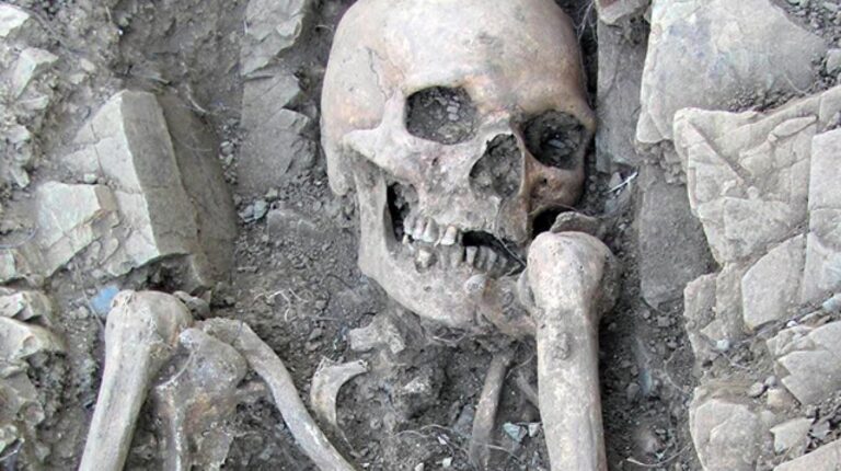 Oldest clinical case of Klinefelter Syndrome was detected in a 1,000-year-old Portuguese skeleton