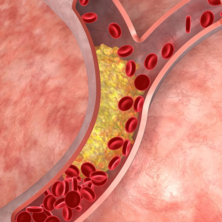 Daily statin reduced the risk of cardiovascular disease in people living with HIV, large NIH study found