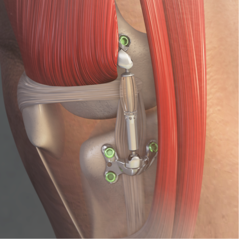 FDA authorizes marketing of MISHA Knee System for people Suffering from knee osteoarthritis