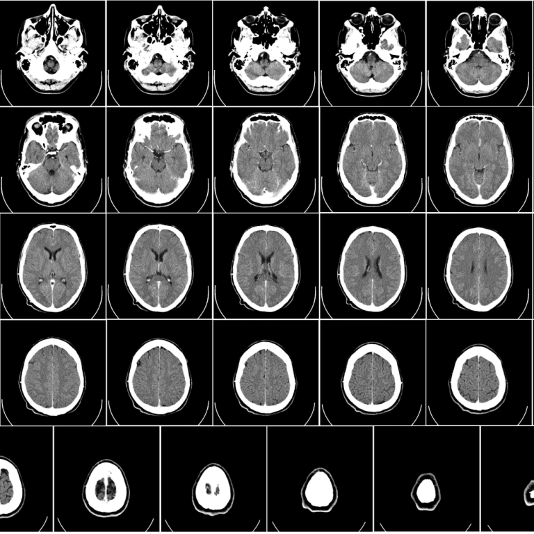 Large-scale study of brain volume found genetic links to Parkinson’s disease and ADHD