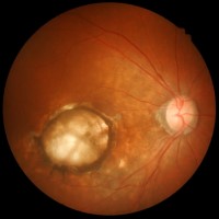 NIH launched first US clinical trial of patient-derived stem cell therapy to replace dying cells in retina