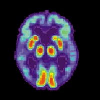 FDA granted traditional approval for LEQEMBIﾮ (lecanemab-irmb) for the treatment of Alzheimerﾒs disease