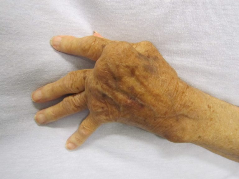 Stanford researchers discovered hereditary arthritis gene