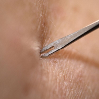 Bifurcated needle for smallpox vaccine introduced