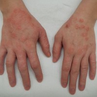 Louis Olivier published “The Penetration of Dermatitis-Producing Schistosome Cercariae”