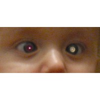 The human retinoblastoma (Rb) gene was cloned