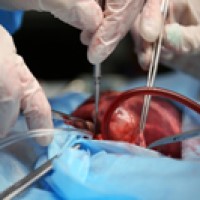 Surgeon Christiaan Barnard performed first human to human heart transplant