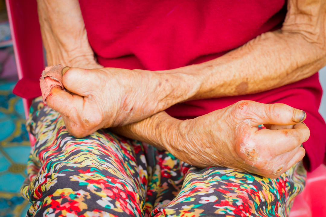 CDC report indicates leprosy is potentially endemic in Florida
