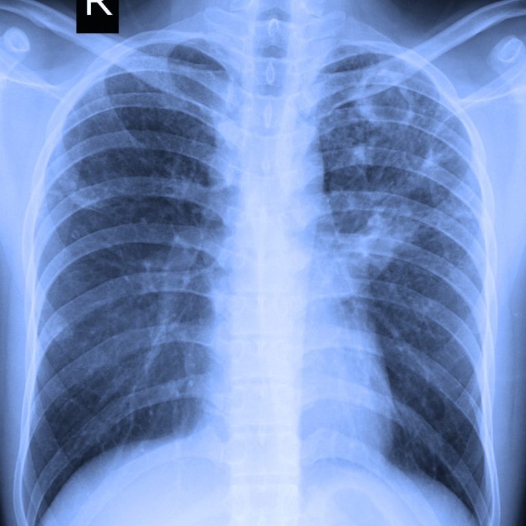 The FDA approved cisplatin (Platinol) for use in combination with other drugs in the treatment of metastatic testicular and metastatic ovarian cancer