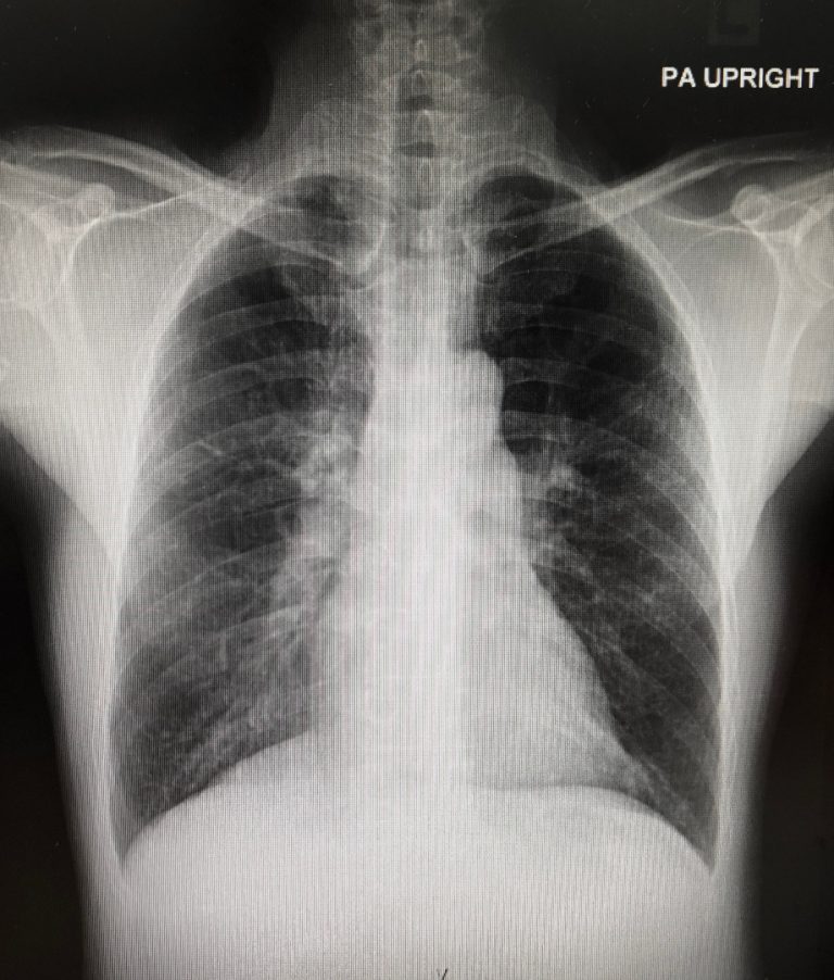 Severe lung infection during COVID-19 caused damage to the heart