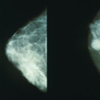 Modified radical mastectomy replaced radical mastectomy for breast cancer