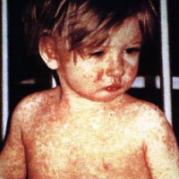 Global measles threat continued to grow as another year passed with millions of children unvaccinated