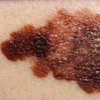 The National Cancer Institute scientists identified an inherited gene that strongly affects risk for the most common form of melanoma