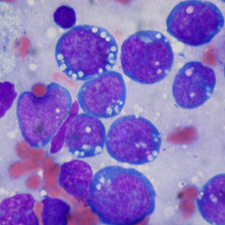 Gene expression profiling can accurately diagnose Burkitt’s lymphoma