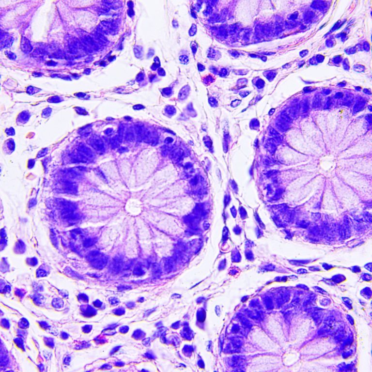 The first gene associated with hereditary nonpolyposis colon cancer was cloned (hMSH2)