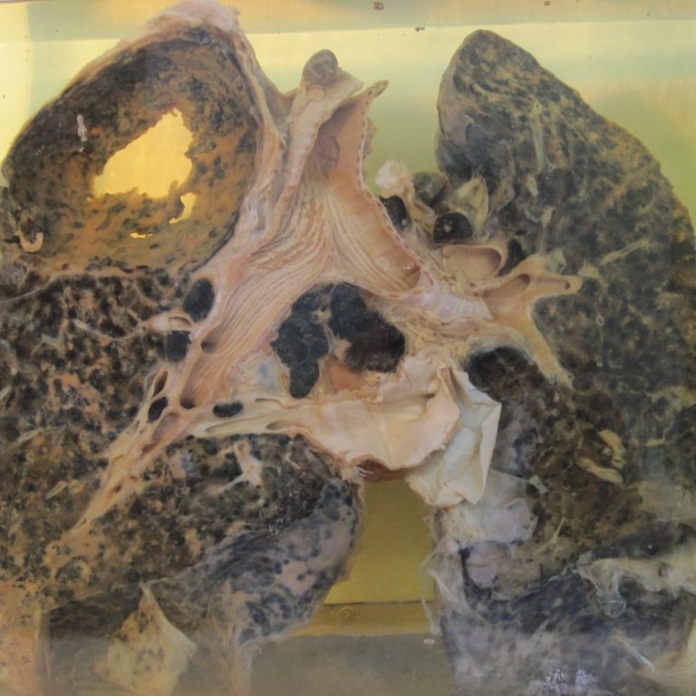 Medical College of South Carolina researchers published artucle that linked brown lung disease (asbestosis) with cancer